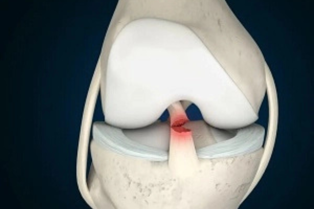 ANTERIOR-CRUCIATE-LIGAMENT