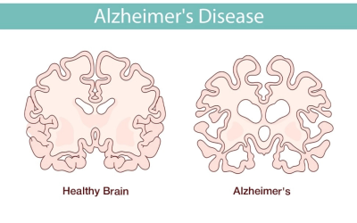 Alzheimer's Disease When forgetfulness Is More Than Just Aging
