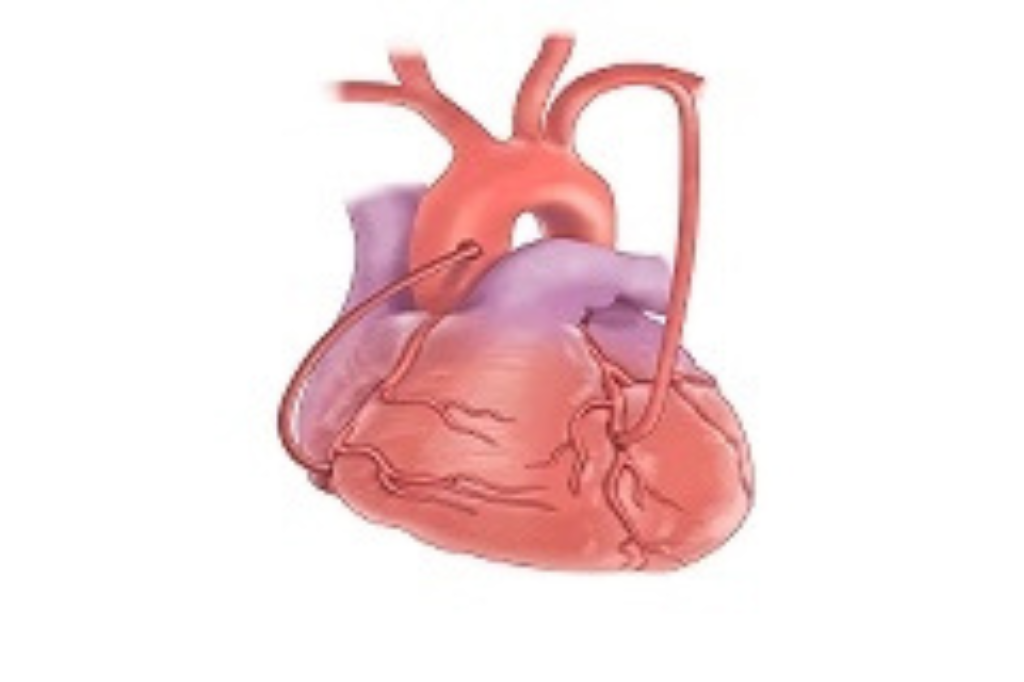 CABG