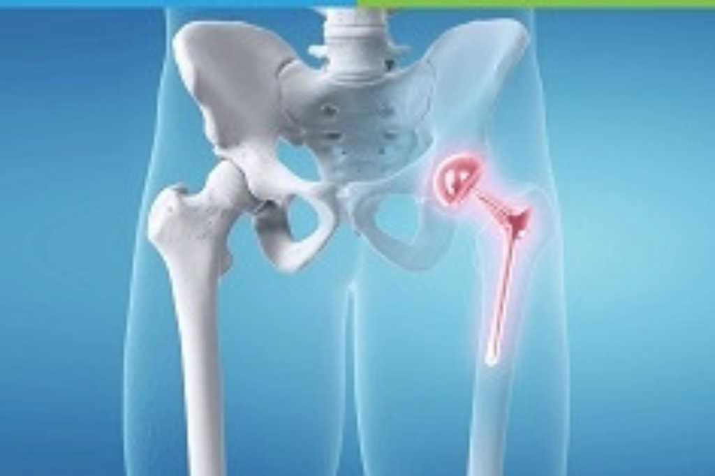 Joint-Replacement