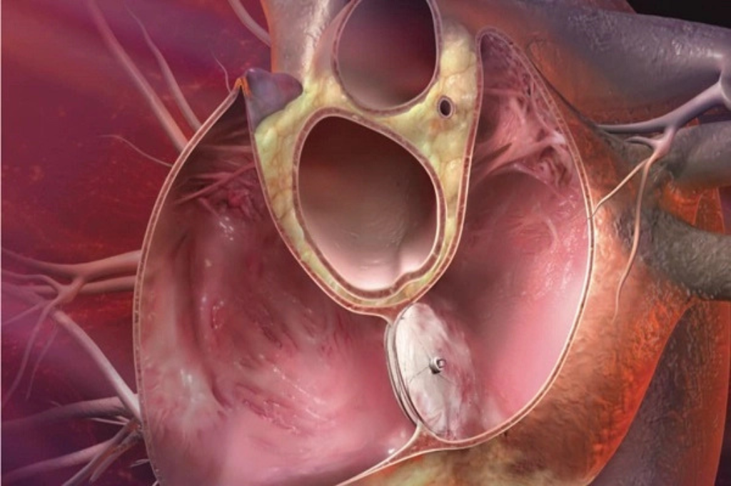 What Do You Mean By A Hole In The Heart?