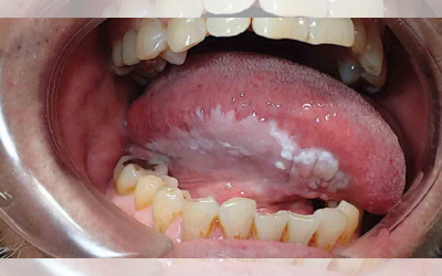 What-is-Leukoplakia