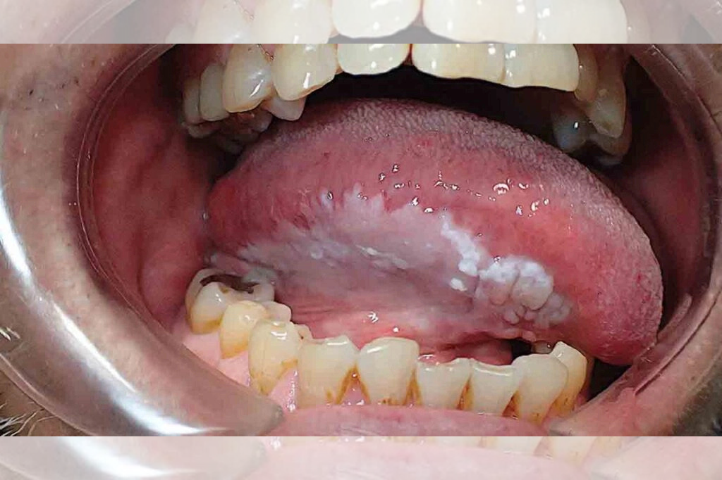 What-is-Leukoplakia