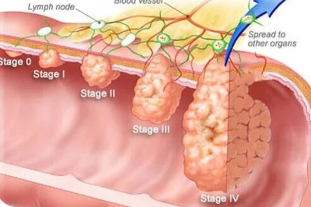What-is-Organ-cancer