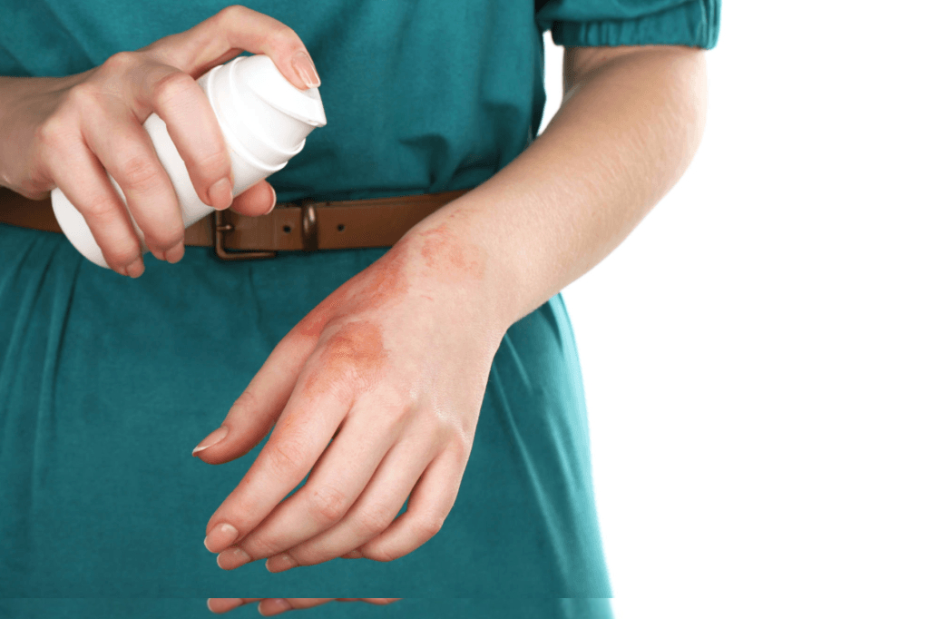 burn-treatment-jalne-par-kya-kare