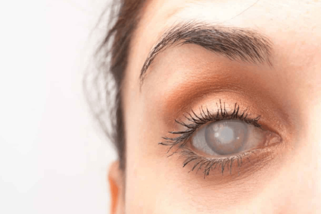 catarct-causes-symptoms-and-treatments