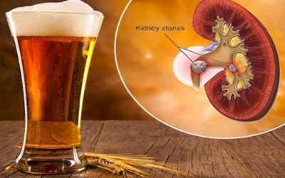 does-beer-help-kidney-stones
