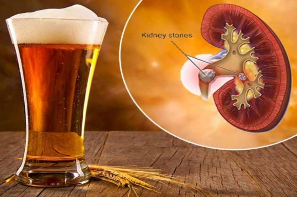 does-beer-help-kidney-stones