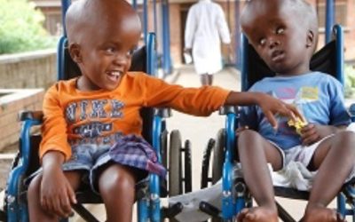 hydrocephalus