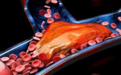know-about-mechanical-thrombectomy
