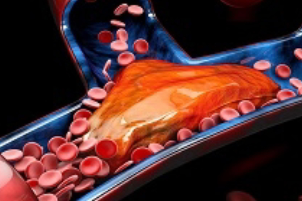 know-about-mechanical-thrombectomy