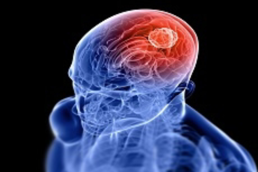 know-more-brain-tumor