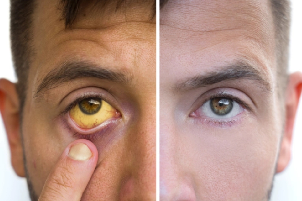 symptoms-jaundice-hindi