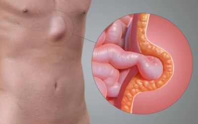 हर्निया-के-प्रकार-Types-of-Hernia-और-लक्षण