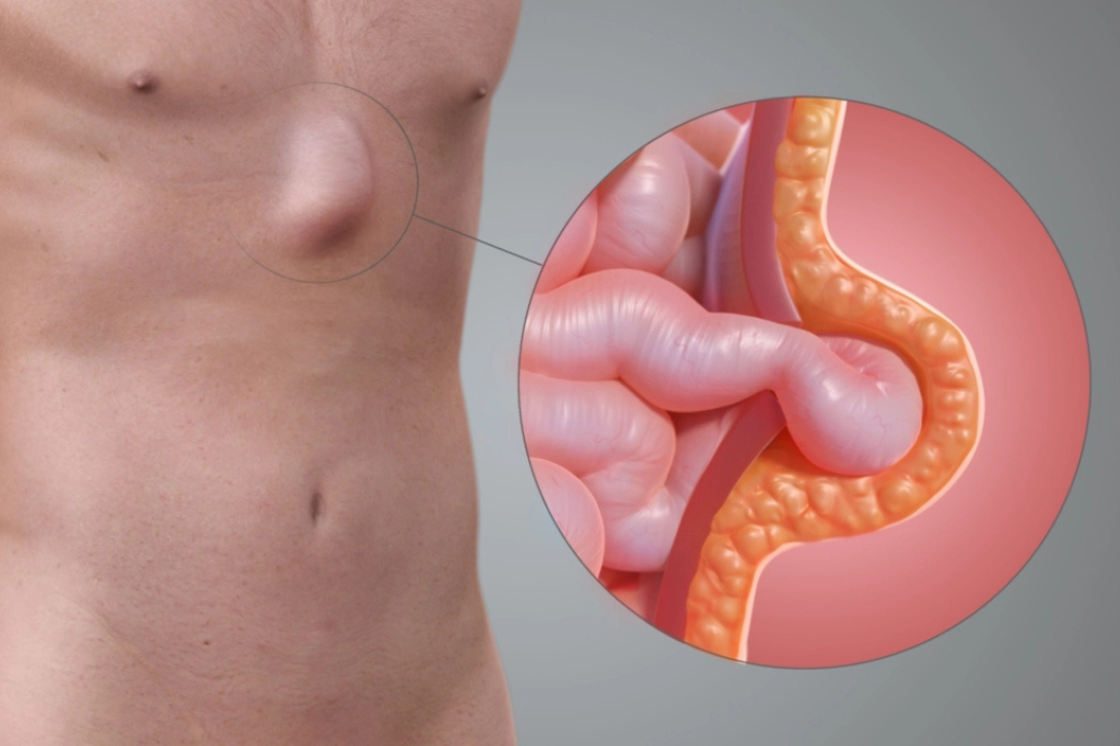 हर्निया-के-प्रकार-Types-of-Hernia-और-लक्षण